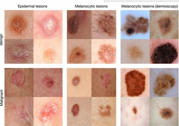 谷歌神经网络等AI技术可通过手机诊断皮肤癌 准确率已高达91%